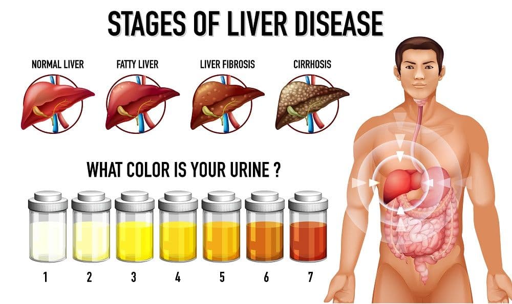 Liver Fibrosis