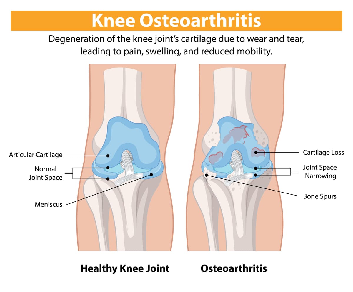 Osteoarthritis: Taking Control of Your Joint Health