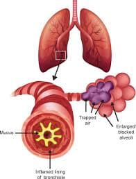 Chronic Obstructive Pulmonary Disease