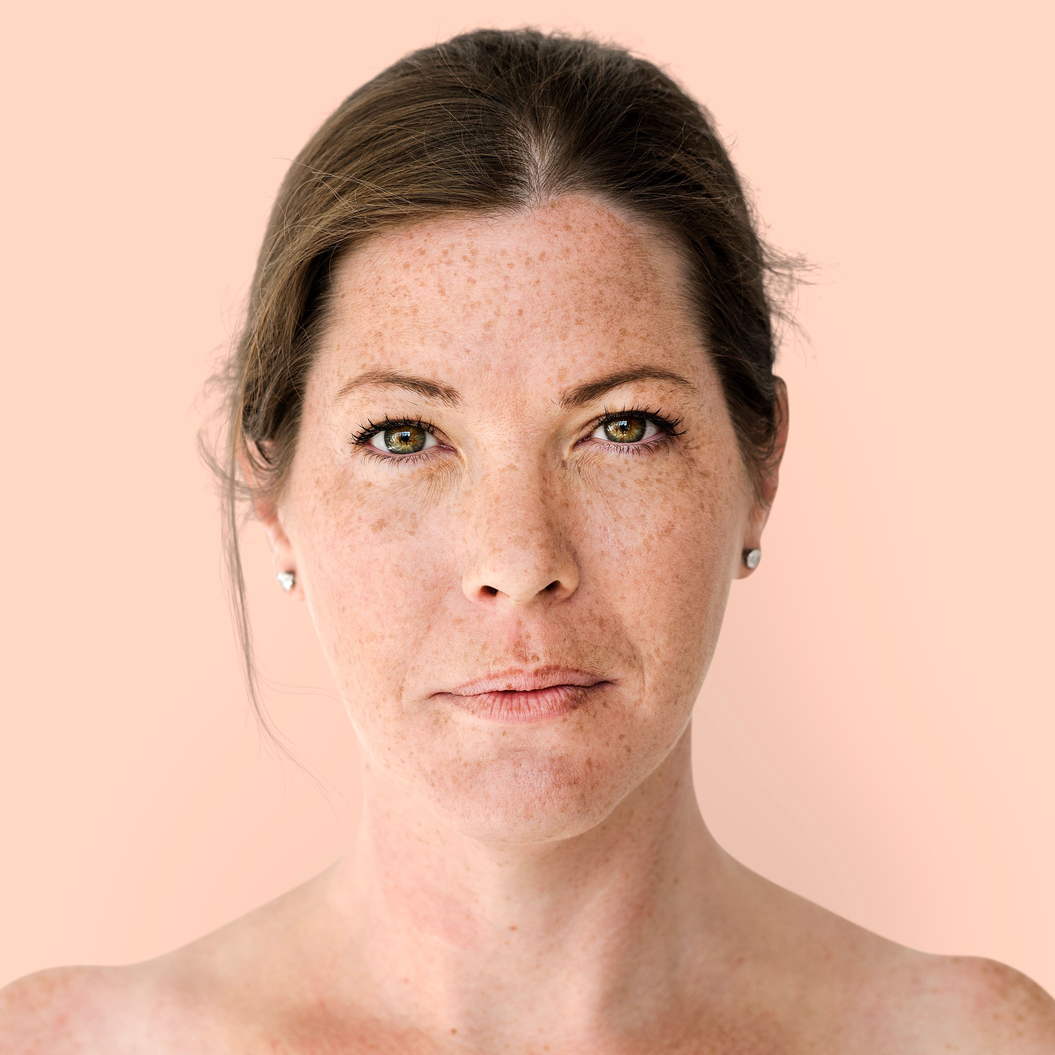 Melasma
