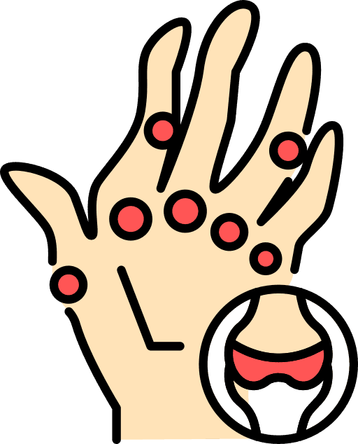 Rheumatoid Arthritis