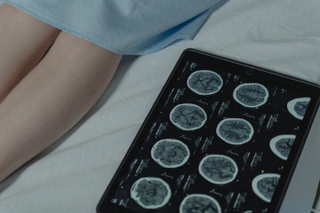 Alzheimer’s Disease